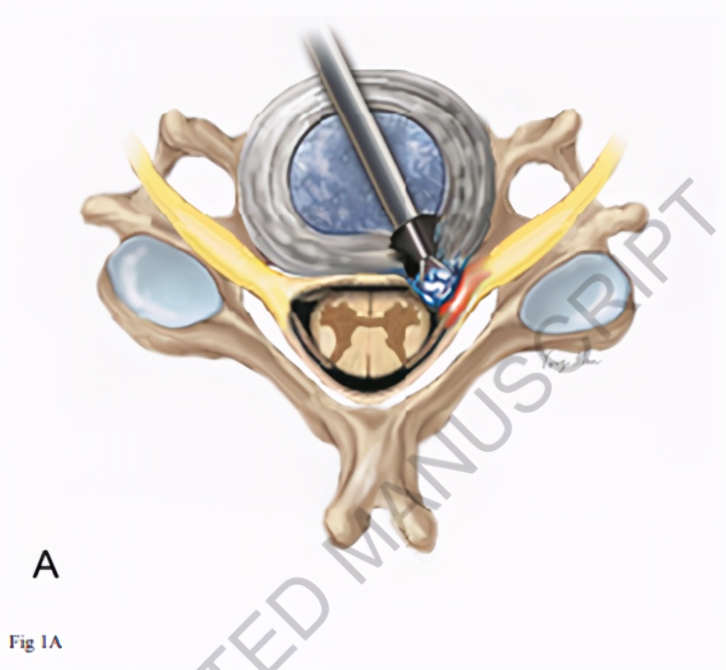 颈椎内窥镜手术效果,颈椎病内窥镜手术