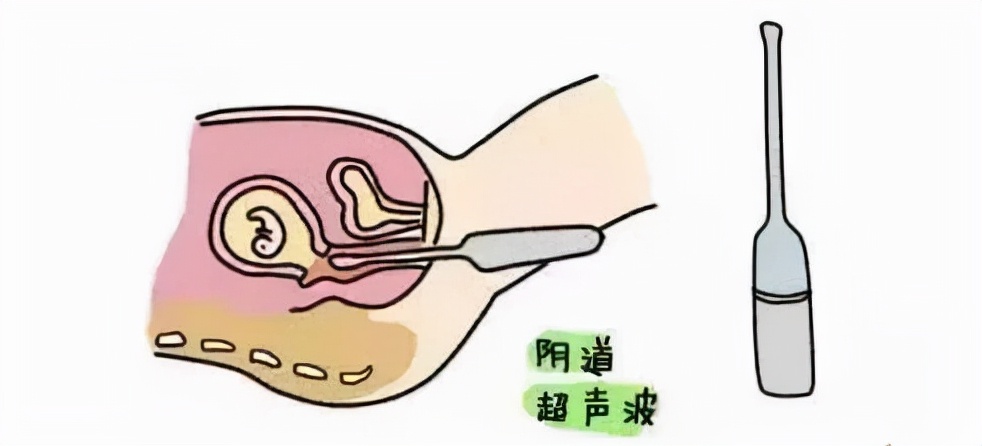 被大多数孕妈忽视的宫颈机能不全