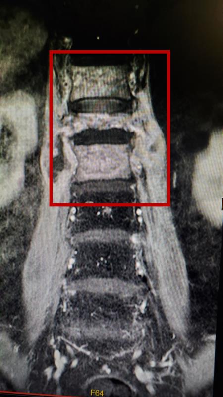 老人腰痛要警惕,老人腰痛没好转要警惕