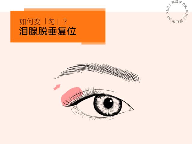 三层眼皮女人的特点,哪种眼皮最好看