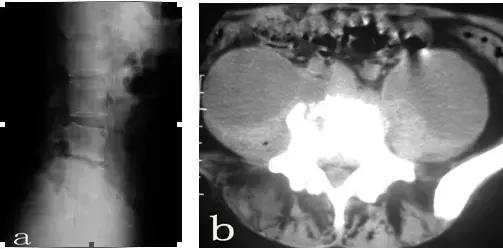腰椎结核吃什么药疗效快,腰椎结核简短介绍