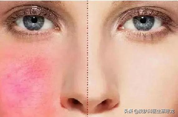 揭秘光子嫩肤的过程,一文看懂光学深度解读