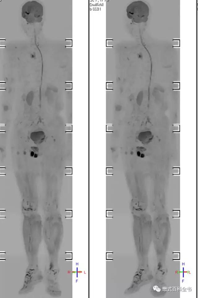 dwi成像序列,dwi序列和edwi序列