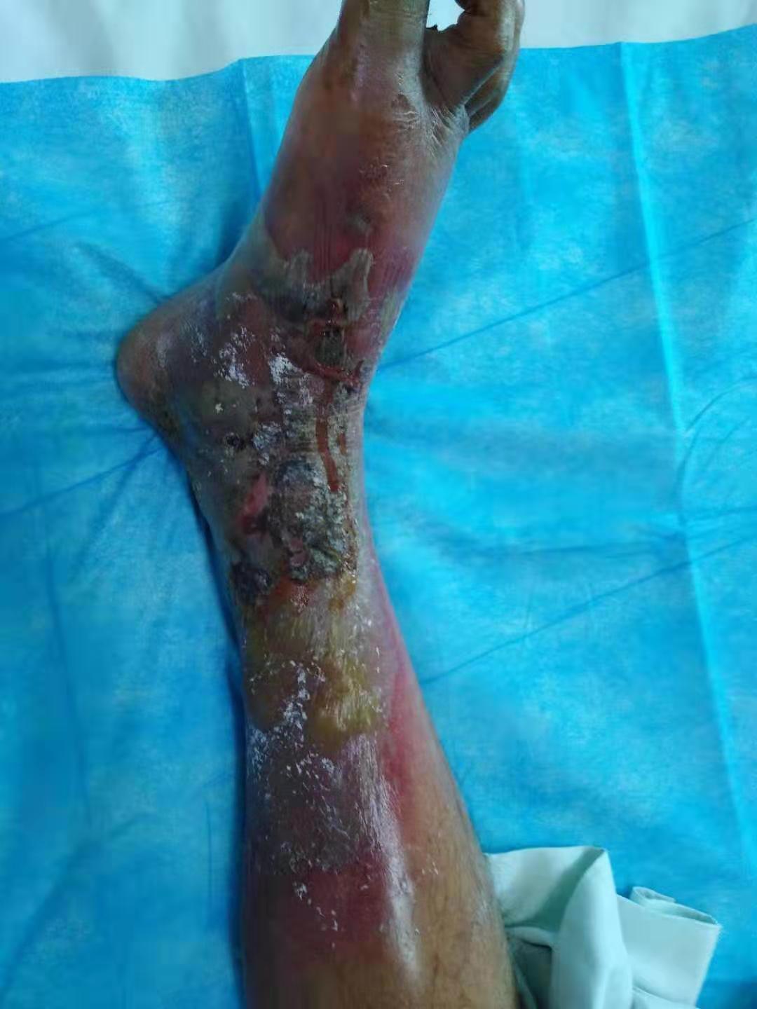 下肢麻木、溃烂要小心，烟酸缺乏是病因