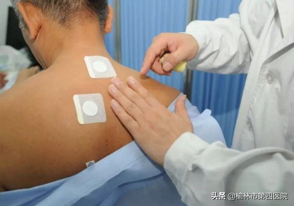 榆林市星元医院“冬病夏治”贴敷治疗项目正式启动