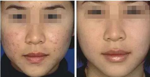 痘肌调理真实案例,痘肌10年了怎么修复