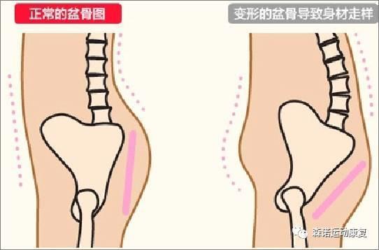 产后腰疼漏尿什么原因,产后腰疼会是腰间盘突出么