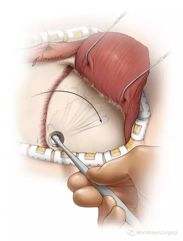 翼点入路技巧图解,翼点入路的开颅要点