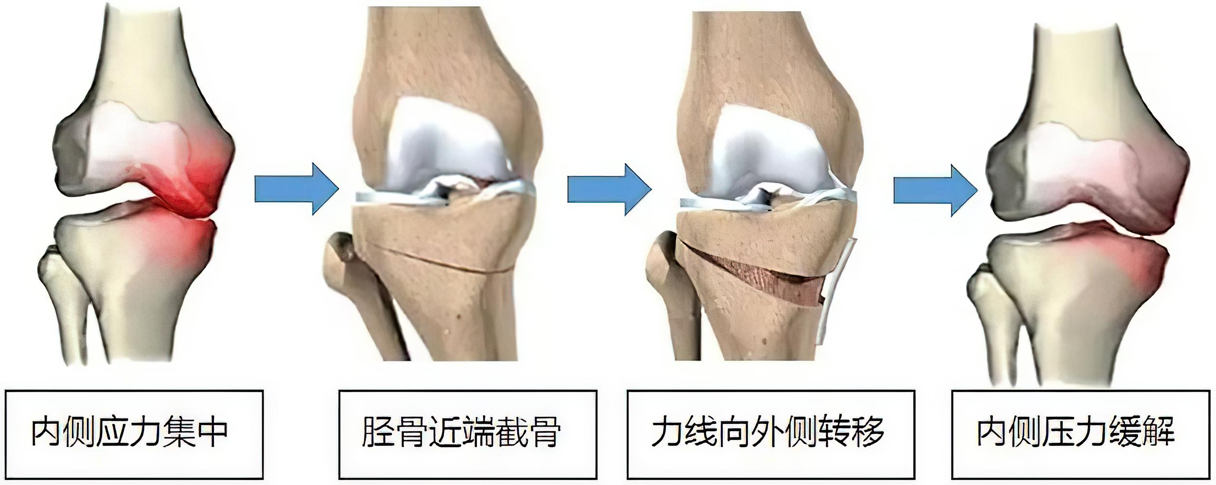 骨关节炎痛风和类风湿都有何症状,痛风关节严重畸形患者能活多久