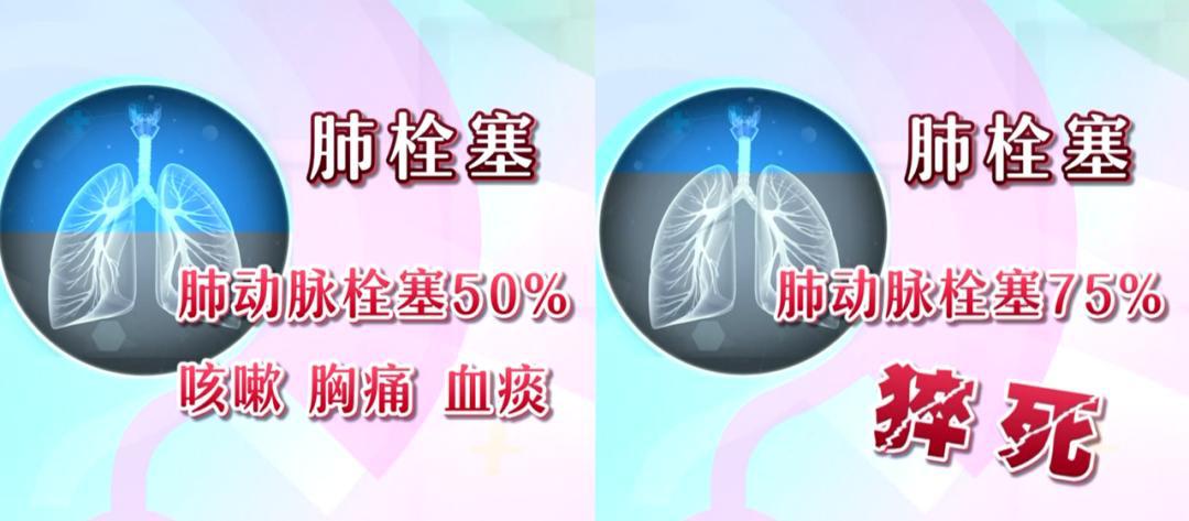 肺栓塞后期注意事项有哪些,下肢血栓预防肺栓塞最好的方法