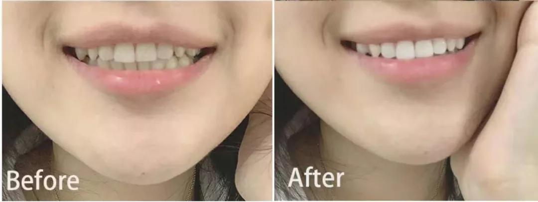 牙黄最有效变白方法,牙黄变白的正确方法学生党