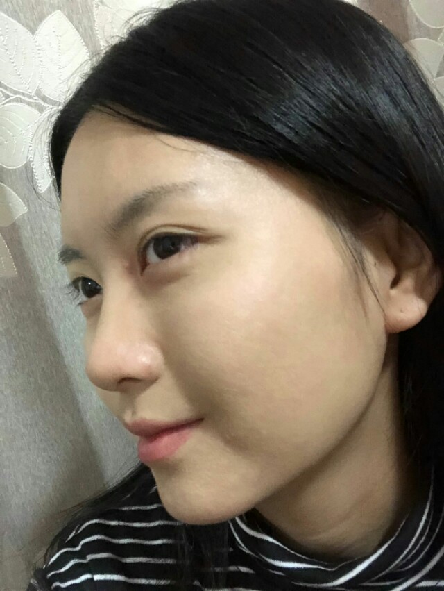 鼻子很高很挺的隆鼻案例,3万元左右的隆鼻效果图