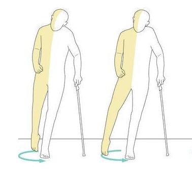 脑梗手挎筐走路画圈能恢复吗,得了脑梗走路走不稳怎么办