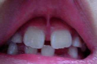 疫情防控期间突然牙痛,疫情之间牙疼我该怎么解决