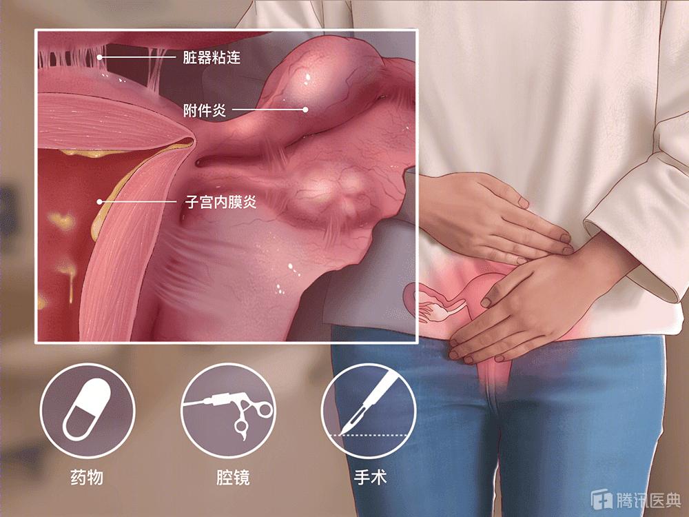 妇科炎症反复发作，医生却让丈夫来检查……