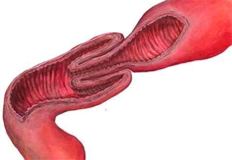 宝宝肠套叠怎么处理,宝宝肠套叠的症状有哪些