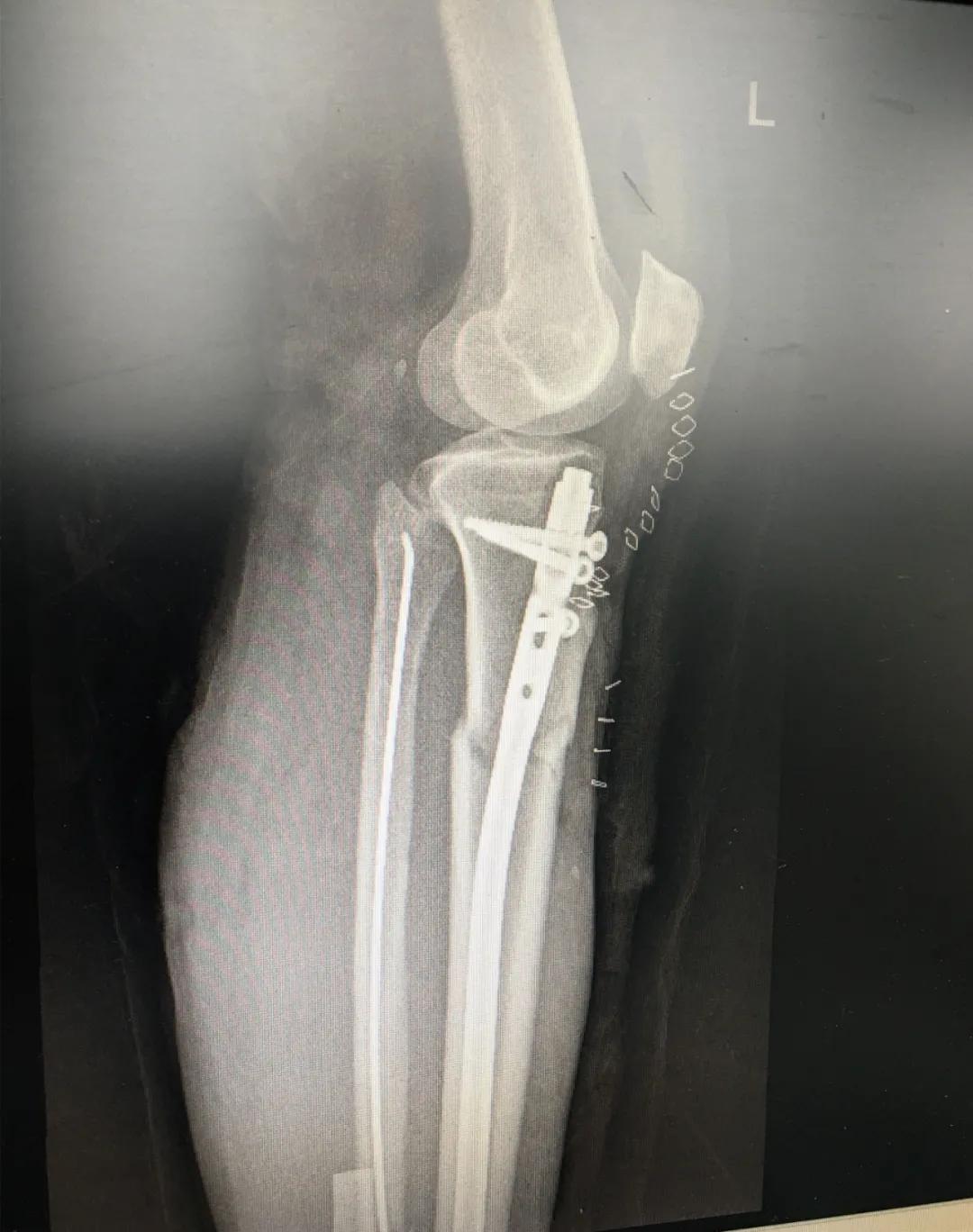 小腿挤压大量淤血能在家自愈吗,小腿碎成三截还能复原吗