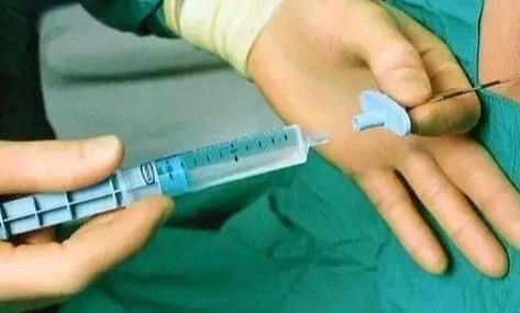 强行保胎胎儿畸形,8个月孕妇产检畸形