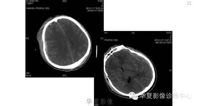 一文读懂颅内胆脂瘤,一文看懂背后的真相