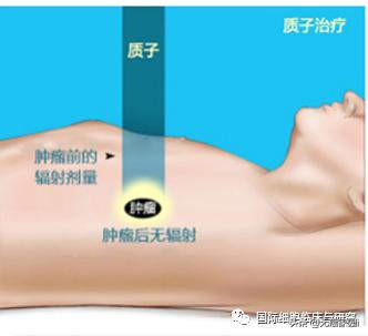 鼻咽癌复发的治愈率高吗,质子重离子治疗鼻咽癌3期