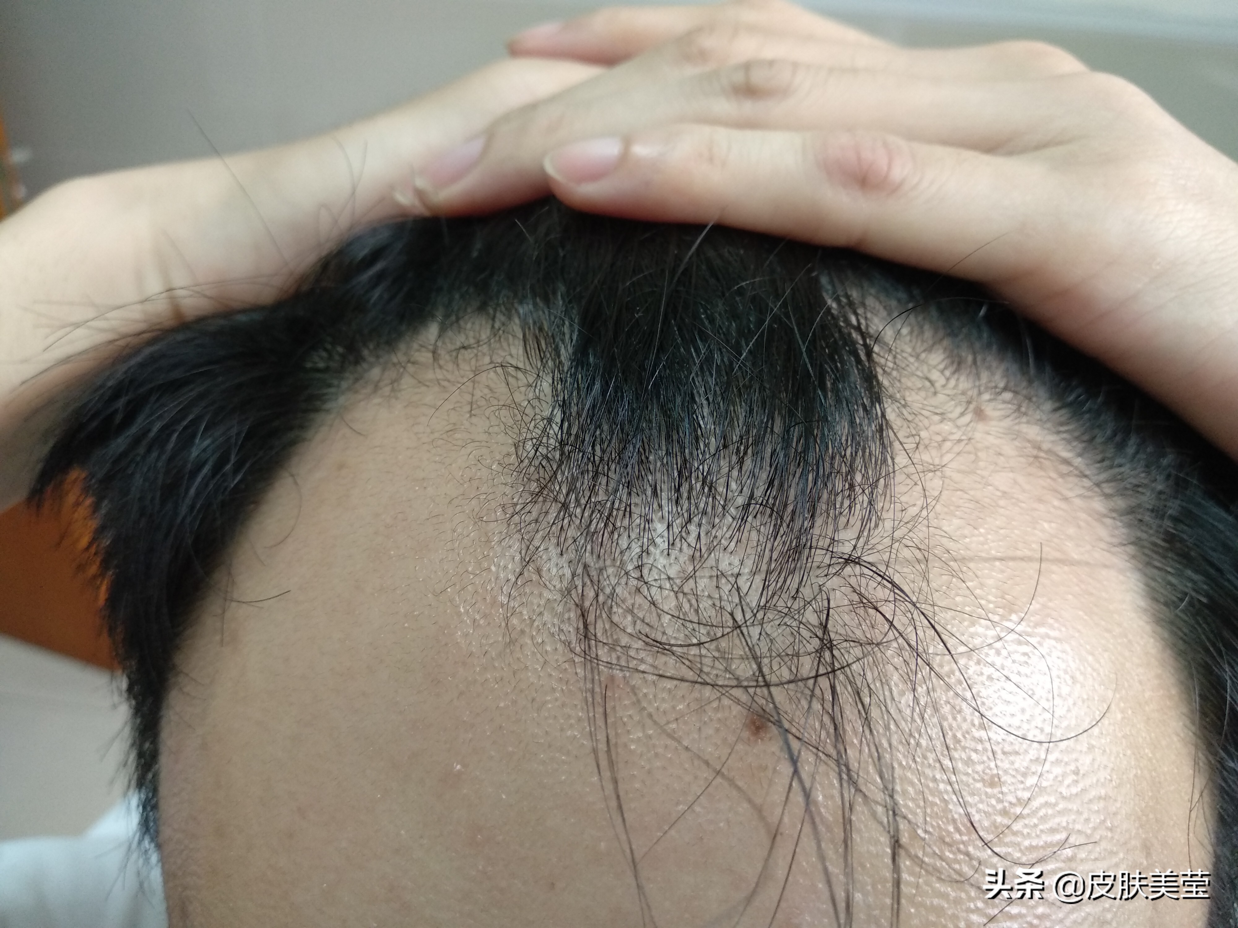 脂溢性脱发不好治,维生素b6能治脂溢性脱发有效果吗