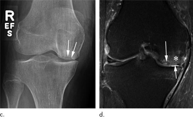 膝关节骨关节炎注射什么药好,膝关节炎注射激素有什么副作用
