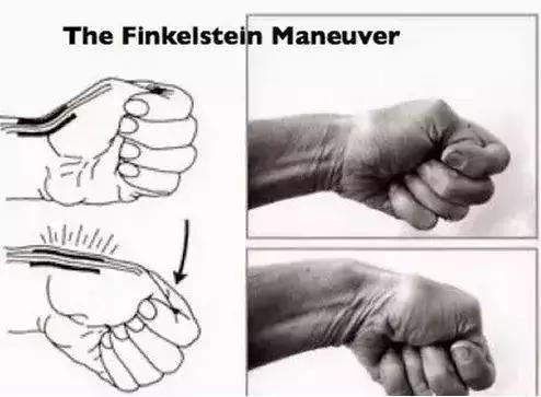 治疗腱鞘炎手腕最快的恢复办法,抱孩子手腕疼能恢复吗