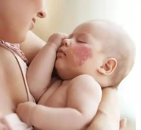 红胎记有时候明显有时候不明显,红胎记颜色浅容易治疗吗