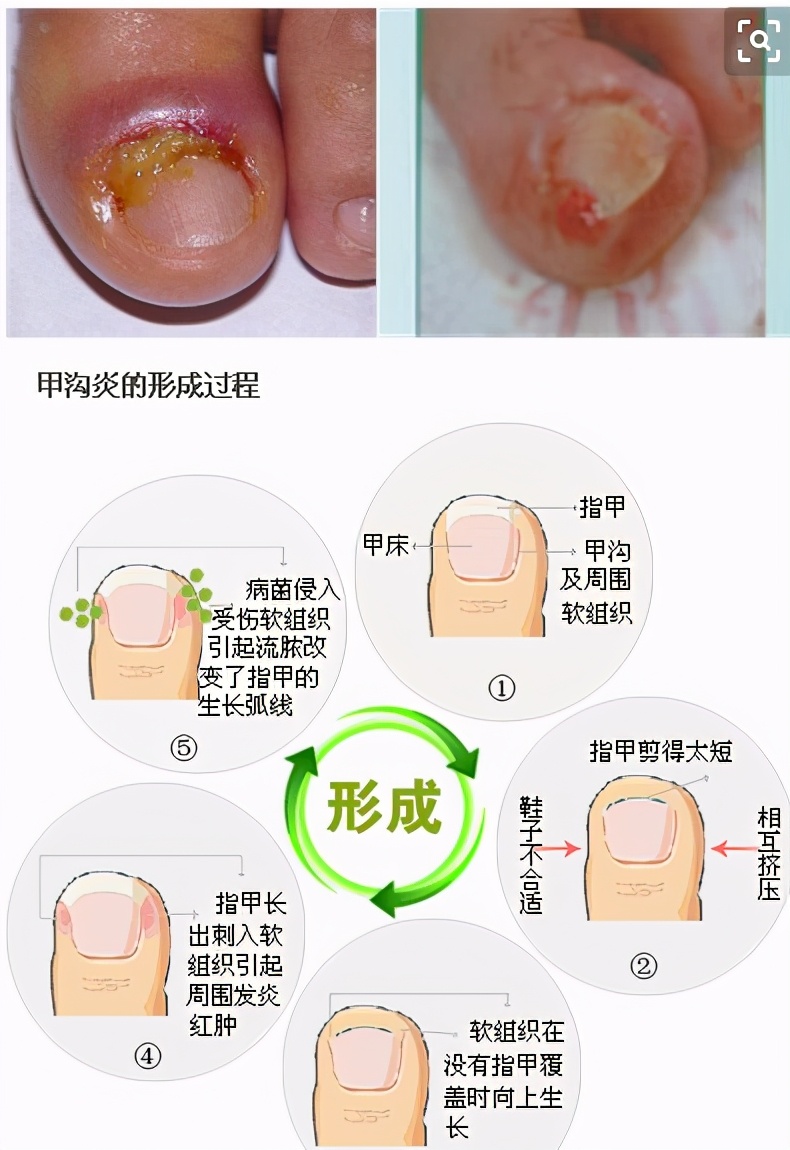 甲沟炎有什么需要注意的事项,甲沟炎恢复过程中会遇到的问题