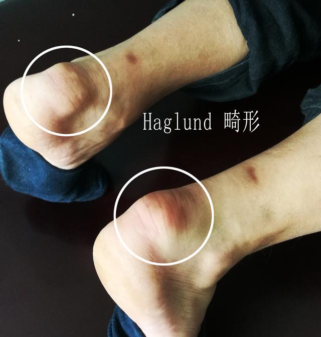 产后足跟痛是什么原因引起的,足跟痛是什么原因用什么贴