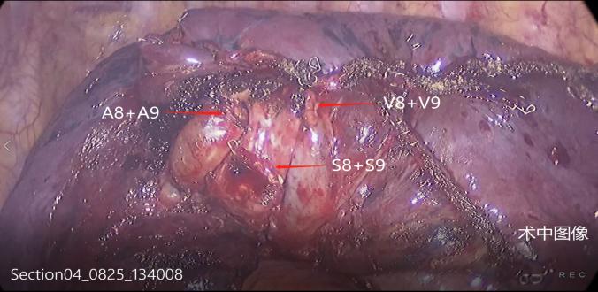 微创医疗最新突破,首例单孔胸腔镜手术