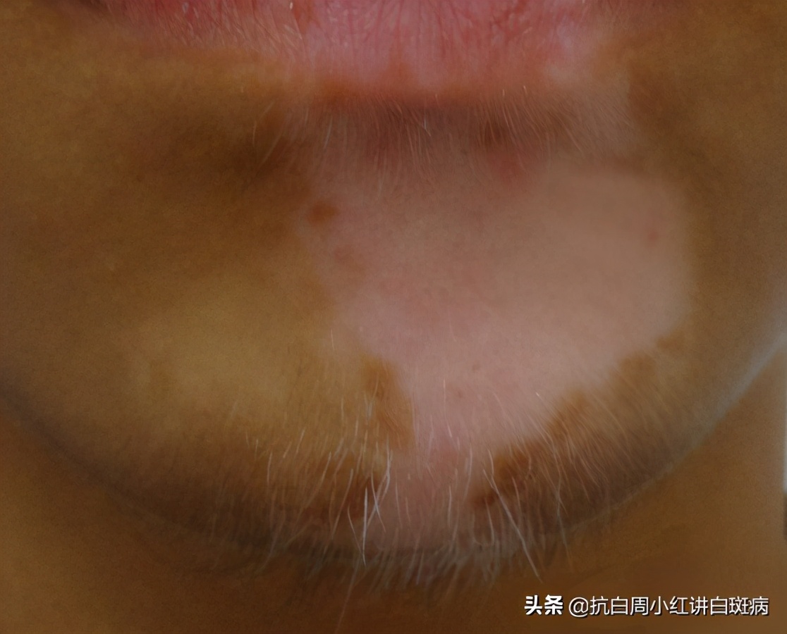 被猫抓伤会不会出现白癜风,撸猫被抓伤有保险吗