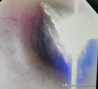 八旬老人误吞枣核肠,老人误吞枣核怎么化解