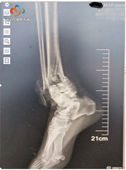 两米跌落脚跟着地引起疼痛,两米高摔下跟骨骨折算严重吗