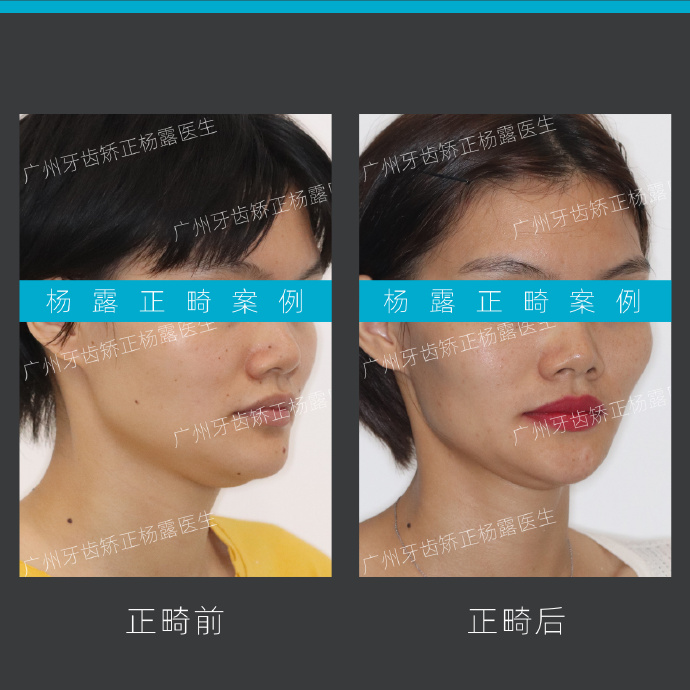 广州牙齿矫正整牙视频,牙齿深覆盖加龅牙怎么矫正