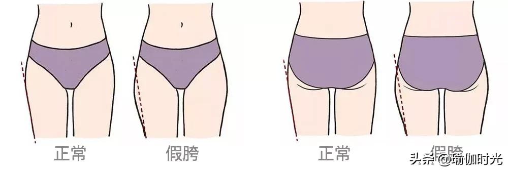 大腿粗，屁股肥，可能是假胯宽！全套矫正方案让你“又窄又瘦”