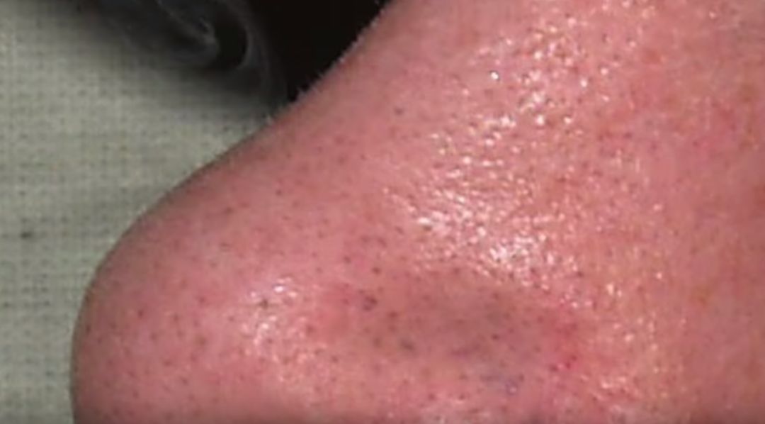 脸部黑头粉刺有必要去美容院挤吗,粉刺黑头应不应该挤掉