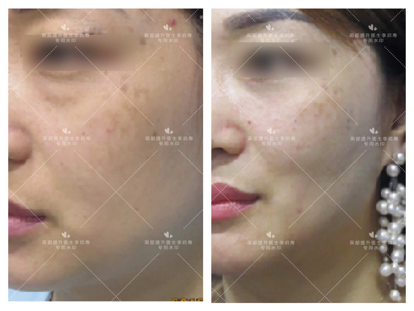 去眼袋苹果肌提升变化图,30岁面部轻微下垂眼袋泪沟