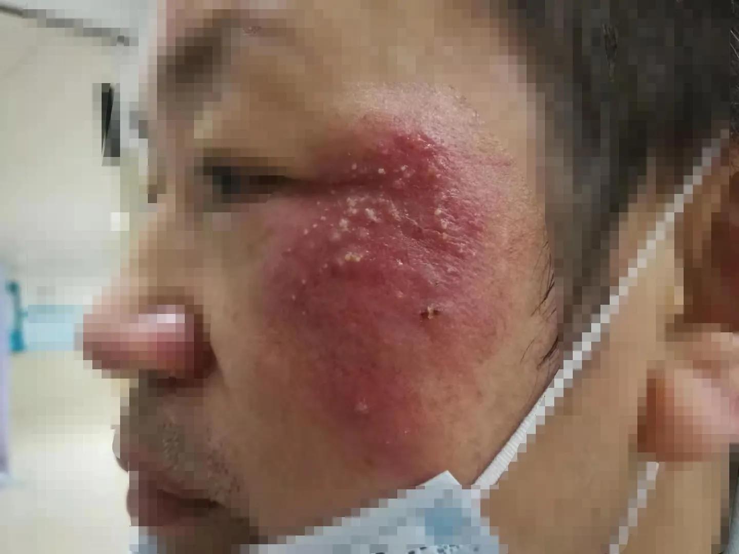 外用药膏一般能维持多久,外用药膏出现不良反应怎么处理