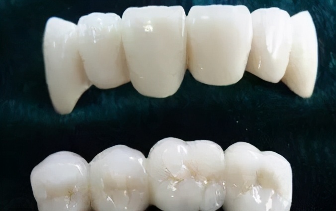 三甲医院全瓷牙保质期,全瓷牙有缝隙保质期是多久
