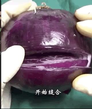 剖宫产简直痛到怀疑人生,剖宫产三次全过程