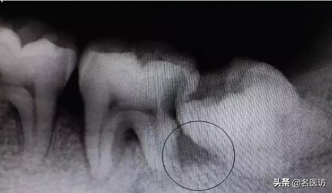 拔智齿有什么禁忌吗,拔智齿有什么禁忌