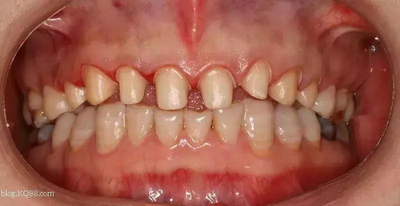 牙釉质透明导致的牙黄怎么美白,去黄美白牙