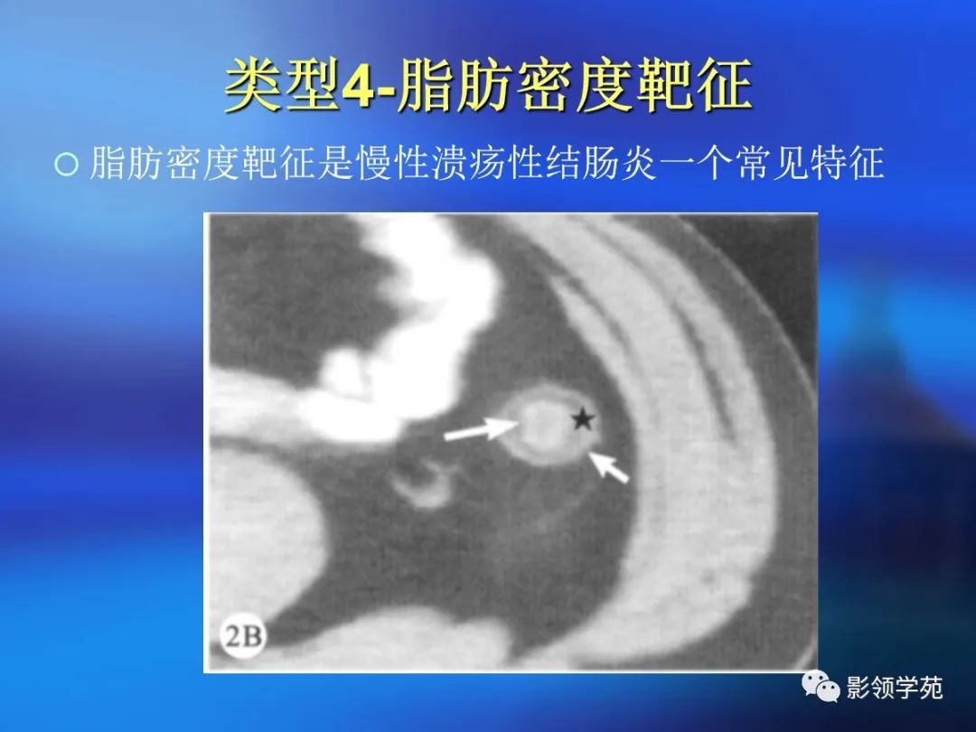 肠道内壁增厚,肠道扩张ct表现