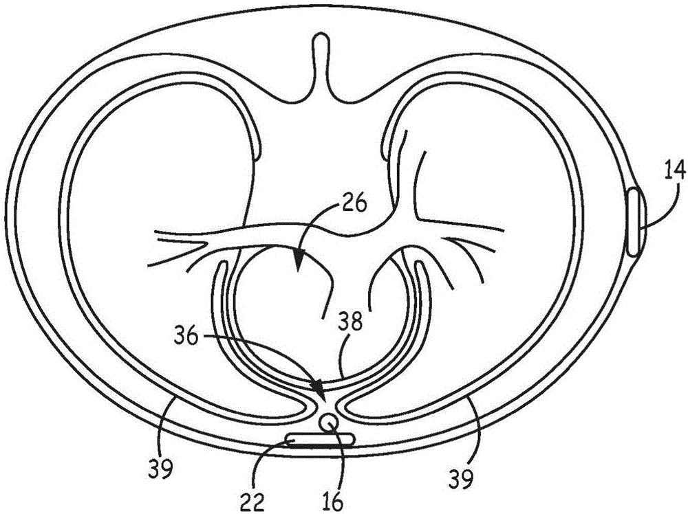 阵发性心动过速可出现呼吸困难，心绞痛，心率过快患者需改善体质