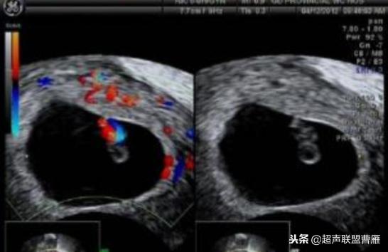 内见卵黄囊,卵黄囊肿瘤