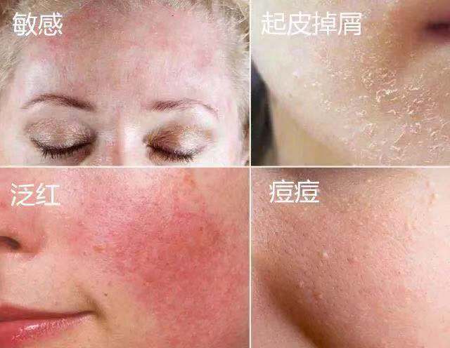 澳洲绵羊油对敏感肌有用吗,澳洲绵羊油保湿霜精华