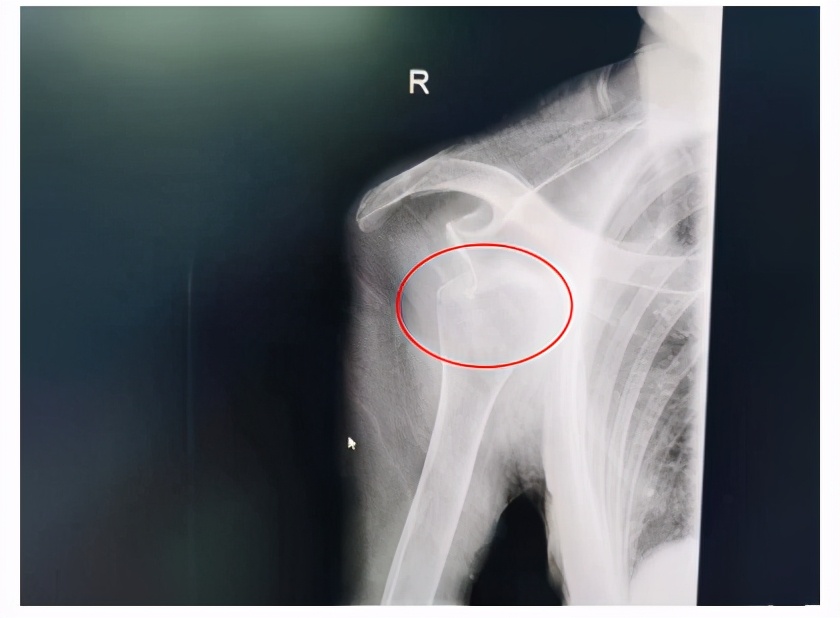 摔倒手掌撑地肩关节会脱位吗,老人摔倒胳膊脱位