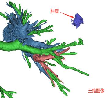 微创医疗最新突破,首例单孔胸腔镜手术