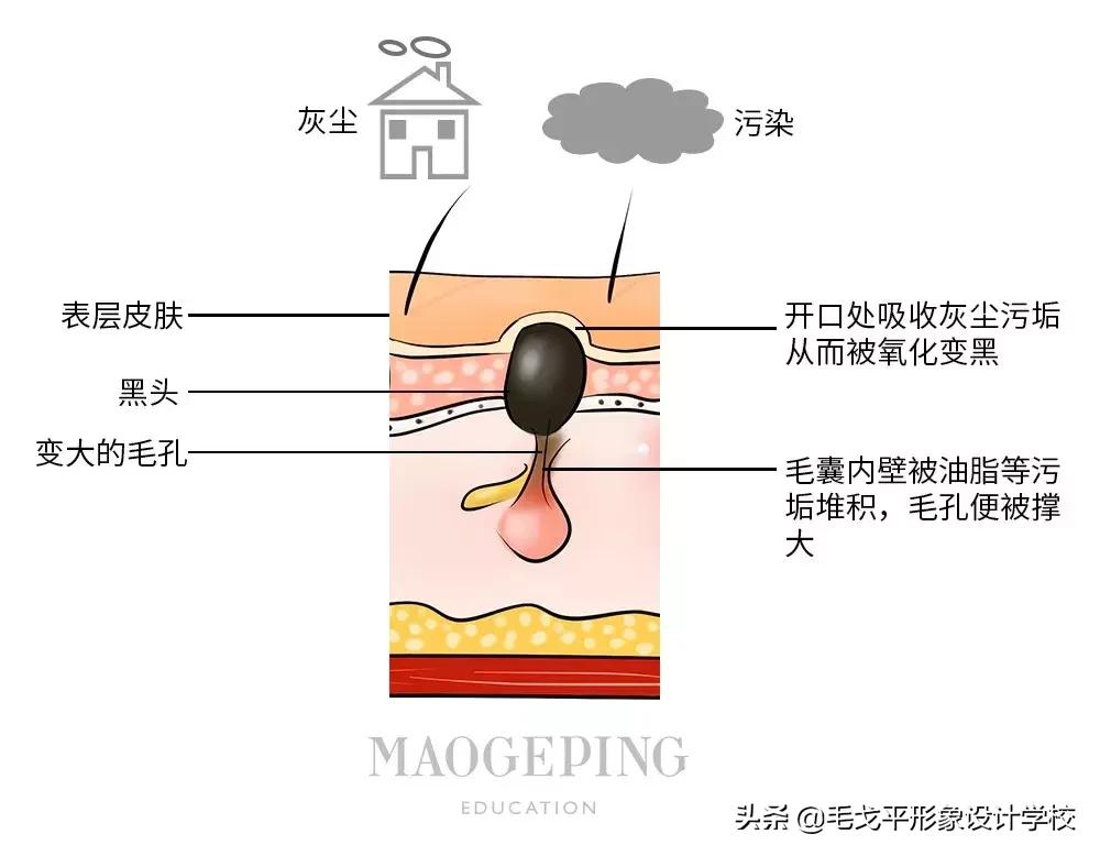 什么药能有效祛黑头治草莓鼻,草莓鼻清理黑头神器
